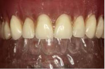 Prueba de la gu�a multifuncional en la boca.