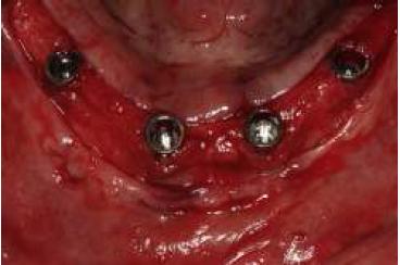 Implantes de hex�gono interno instalados.