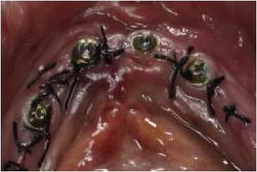 Pilares mini-abutment instalados y tejidos suturados.