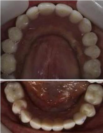 Vista oclusal de prótesis híbridas.