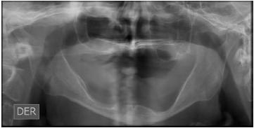 Radiografía panorámica inicial.
