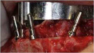 Cirugía de implantes maxilar inferior.