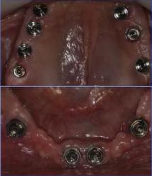 Implantes conectados mediantes pilares cónicos.