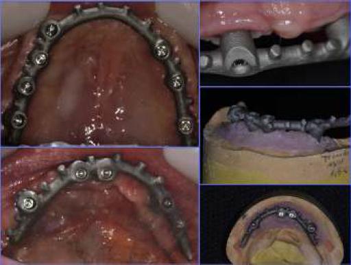 Subestructuras para prótesis híbridas realizadas en aleación Cr-Co mediante sinterizado láser.