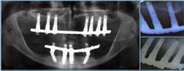 Control radiográfico subestructuras Cr-Co.