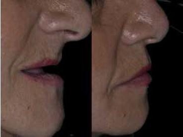 Fotos de perfil con y sin prótesis híbridas.