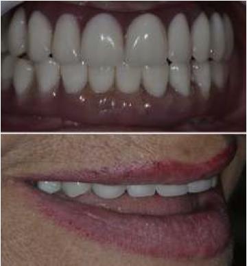 Prótesis híbridas terminadas.