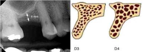Radiograf�a periapical (zona primer molar superior) que muestra una disponibilidad �sea vertical de 6 mm (izquierda); esquematizaci�n de densidad �sea tipo 3 y tipo 4 (derecha).