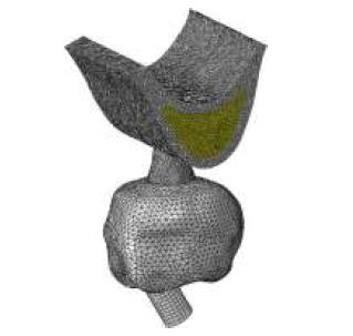 Esquematizaci�n del modelo 3D en el que se observa adherido a la corona la pieza adicional.