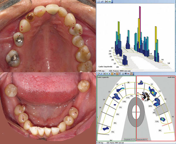 Comparaci�n de los arcos dentarios con el registro en m�xima intercuspidaci�n, con Accufilm� II (Parquel). Imagen digital de T-Scan� III. Columna azul: fuerzas bajas. Columna roja: contactos fuertes.