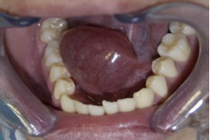 Imagen clínica de ránula gigante intraoral. Lesión ovoidea sublingual 5 cm derecha, de color translúcido, con elevación y desviación lingual hacia el lado contralateral