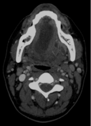 Corte axial donde se observa una masa unilocular, ovalada, de baja densidad (densidad líquido), confinada al espacio sublingual en relación con ránula simple