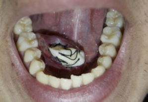 Imagen clínica postoperatoria inmediata de ránula marsupializada. Obsérvese gasa medicada en el centro de la cavidad como elemento de contención para que no colapse la cavidad. Obsérvese sutura que involucra el margen de la mucosa oral y la membrana quística