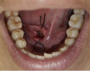 Imagen clínica de ránula marsupializada después de 10 días. Se ha retirado el elemento de contención, apreciándose la cavidad quística suturada a la mucosa del piso de la boca