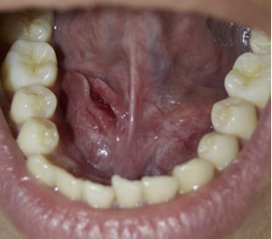 Imagen clínica posmarsupialización a los 30 días. Franca mejoría de la lesión. Con persistencia de cavidad aún comunicada con medio bucal