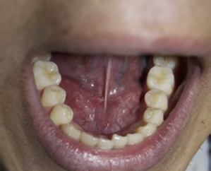 Imagen clínica tras 12 meses. Mucosa del piso de la boca indemne, sin signos de recidiva y con aspecto de brida cicatricial