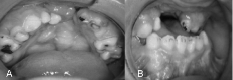 A. Fotografía intraoral previa al tratamiento. Se observa la ausencia de premaxila y de varias piezas dentarias, falta de continuidad en el reborde alveolar, múltiples lesiones de caries y obturaciones deficientes. B. Se observa la oclusión, con una severa mordida invertida y la ausencia de piezas dentales anteriores