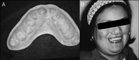 A. Fotografía de la cara interna de la sobredentadura; se observa la extensión del flanco palatino de modo que este actúa como obturador de la fístula buconasal. B. Fotografía de semiperfil de sonrisa de la paciente con la sobredentadura. Se aprecia una mejoría notoria en la estética de su sonrisa