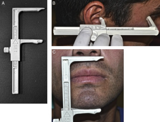 A. Crane�metro de Knebelman por su lado SET, con sus brazos, el superior fijo y el inferior m�vil, con su tornillo de fijaci�n. B. Procedimiento de medici�n con el crane�metro de Knebelman por su lado READ. C. Procedimiento de medici�n con el crane�metro de Knebelman por su lado SET