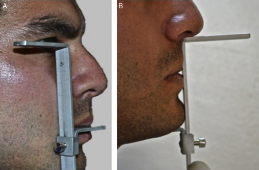 A. Procedimiento de medici�n con el comp�s de Willis desde el canto externo del ojo a la comisura. B. Procedimiento de medici�n con el comp�s de Willis desde subnasal al borde del ment�n