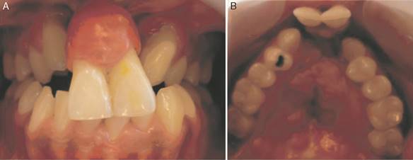 A) Foto intraoral inicial de la paciente en oclusión, vista frontal. B) Foto intraoral oclusal del maxilar, se observa la forma de la premaxila y la fisura palatina operada.