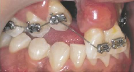 Foto intraoral al inicio de la aparatología fija, conla cual se busca nivelar la premaxila. Nótese la fisura con una amplia brecha y la mejoría en el escalón.
