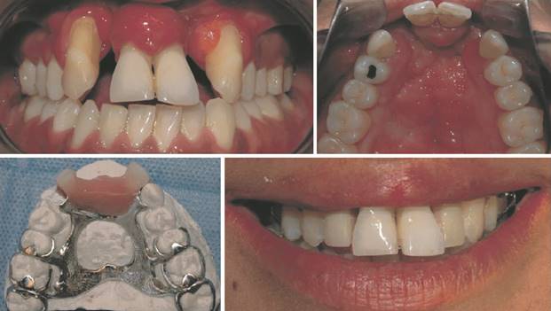 En la siguiente secuencia de fotos se muestra a la paciente con la fase de ortodoncia terminada, y la instalación de la prótesis acrílica, como fase intermedia, antes de realizar el tratamiento final con prótesis metálica y la base metálica.
