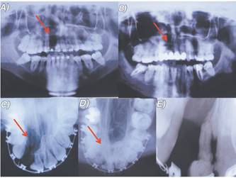 A. Radiograf&iacute;a panor&aacute;mica de fisura unilateral derecha. Paciente en inicio de tratamiento de ortodoncia. B. Radiograf&iacute;a panor&aacute;mica luego de tratamiento rehabilitador finalizado. C. Radiograf&iacute;a oclusal de fisura unilateral derecha. D. Radiograf&iacute;a oclusal luego de injerto &oacute;seo en zona de fisura palatina. E. Radiograf&iacute;a periapical de pieza 1.1 en relaci&oacute;n a zona de la fisura.