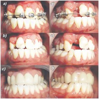 Fotograf&iacute;as frontales de arcadas en oclusi&oacute;n (a-c). Fotograf&iacute;as laterales derechas de arcadas en oclusi&oacute;n (d-f)a. Paciente durante tratamiento de ortodoncia con aparatolog&iacute;a fija. b. Paciente al terminar tratamiento de ortodoncia. c. Paciente al finalizar tratamiento rehabilitador mediante pr&oacute;tesis fija plural con pilares en piezas 1.3,2.1 y 2.2, para rehabilitar piezas 1.1 y 1.2. N&oacute;tese adem&aacute;s porcelana rosada para mejorar la falta de contorno gingival en relaci&oacute;n a la fisura.