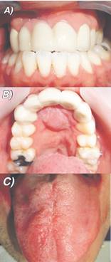 A. Fotograf&iacute;a frontal en oclusi&oacute;n de paciente con tratamiento finalizado. B. Injerto de mucosa lingual en zona de f&iacute;stula palatina, luego de finalizado el tratamiento integral. C. Mucosa lingual posterior a cicatrizaci&oacute;n de cirug&iacute;a para toma de injerto