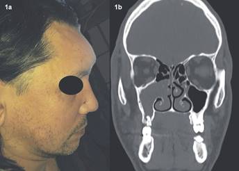 (a) Fotografía Clínica primer día de hospitalización, (b) Imagen de la TC corte frontal, a la altura de diente 1.7.