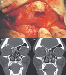 (a) Imagen intraoperatoria vaciamiento quirúrgico del seno frontal, se aprecia ventana ósea patológica de 4cm x 2cm aprox. (b y c) TC Corte frontal, se visualiza compromiso del techo orbitario.