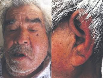 (a) Fotografía clínica frontal: se aprecia aumento de volumen en región parótido-maseterica. (b) Fotografía clínica lateral: se aprecia borramiento del surco pretraqueal debido al aumento de volumen.