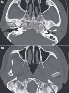 TC corte axial; (a) se observa perforación de la pared anterior del CAE izquierdo, con burbujas aire en su interior; (b) se observa inflamación y burbujas de aire en capsula articula ATM izquierda.