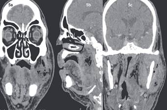 TC con contraste, (a) corte frontal, se aprecia gran aumento de volumen región terigomandibular y espacio masticatorio en general, (b) corte parasagital izquiedo, se observa compromiso inflamatorio y burbujas de aire en espacio laterofaringeo; (c) corte frontal a la altura de la vía aérea, se aprecia severo estrechamiento de la vía aérea por compromiso del espacio laterofaringeo.
