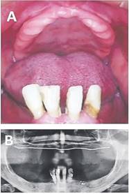 Desdentado total superior, con reborde m&oacute;vil anterior y extrema reabsorci&oacute;n &oacute;sea. Remanencia de dientes anteroinferiores con indicaci&oacute;n de exodoncia. b: La radiograf&iacute;a muestra el m&iacute;nimo nivel &oacute;seo (l&iacute;nea blanca).N&oacute;tese condici&oacute;n de reborde y piezas remanentes mandibulares.