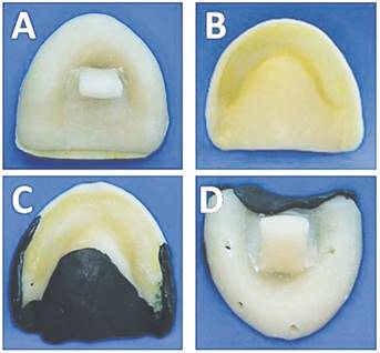Cubeta individual con mango central. b: Espaciado en zona de reborde m&oacute;vil. c:Impresi&oacute;n de zonas de sellado perif&eacute;rico y principal con compuesto de modelar. N&oacute;tese la extensi&oacute;n sobre toda el &aacute;rea palatina. d:Perforaciones vestibulares y palatinas del espaciado.