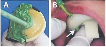 Carga de la cubeta con silicona solo en la zona posterior. b:Una vez asentada en boca ,relleno del espaciado mediante punta aplicadora. N&oacute;tese el escurrimiento de material por el orificio palatino (flecha).