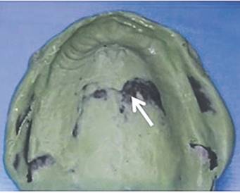 definitiva. N&oacute;tese la continuidad del borde del flanco vestibular y la correcta aplicaci&oacute;n de presi&oacute;n de asentamiento, al traslucirse el compuesto de modelar en la zona palatina (flecha).