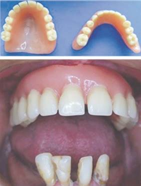 terminadas. La pr&oacute;tesis inferior inmediata y se instalar&aacute; una vez realizadas las exodoncias.