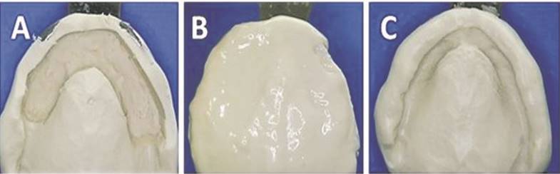 a: Impresi&oacute;n preliminar espaciada en zona de reborde m&oacute;vil. b: Rebasado con hidrocoloide irreversible fluido. c: Impresi&oacute;n terminada.
