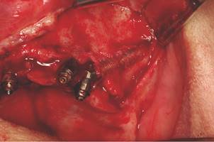 Alveolar fenestration and loss of zygomatic fixation.