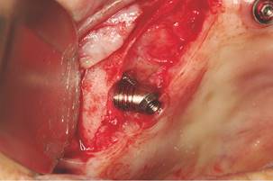 Bone loss due to the screw hole prosthetic.