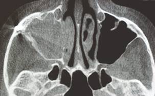Sinus pathology resulting from zygomatic implant.