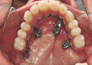 Positioning of palatal implants generating a lever arm on the prosthesis.