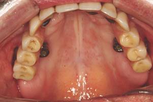 Access palatal of zygomatic implant.