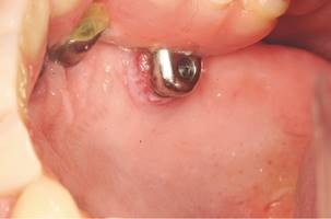 Mucositis caused by zygomatic implant.