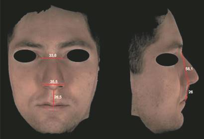 El investigador (S.V) ejemplifica con su rostro la medici&oacute;n fotogram&eacute;trica que se llev&oacute; a cabo con las im&aacute;genes 3D obtenidas de los voluntarios, mediante el uso del visualizador Planmeca Romexis&reg;. La unidad de medida fue el mil&iacute;metro.