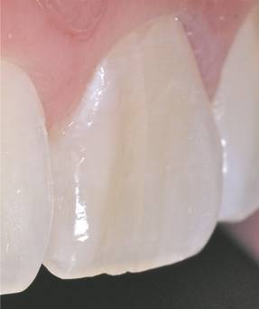 Fractura incompleta vestibular en dirección cérvico-incisal