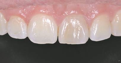 Patrón de superficie de incisivos centrales